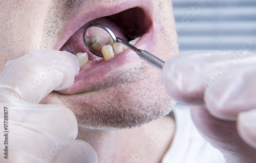 Fototapeta Closeup teeth, dental health care clinic with missing tooth