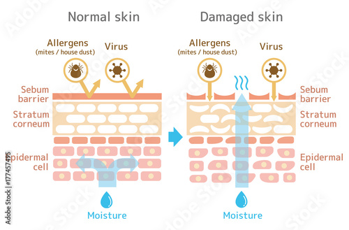 Sectional view of the skin.Comparison illustration of protection effect between healthy skin and wounded skin. With text. photo