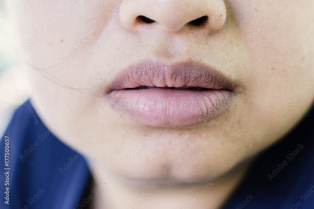 Fototapeta premium Closeup Mouth of asian woman with brittle and dry lips, concept lip salve and wounds