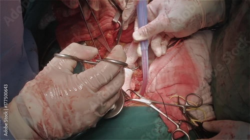 Vascular surgeon team replace infrarenal aorta for patient who had abdominal aortic aneurysm photo