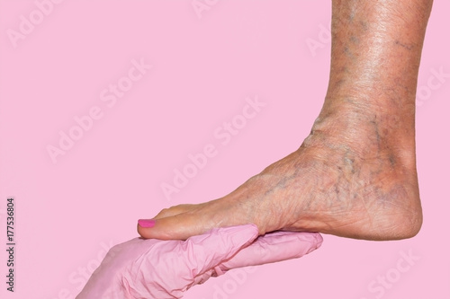 Lower limb vascular examination because suspect of venous insufficiency. photo