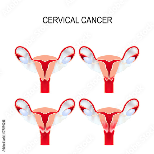 Cervical cancer staging.  Carcinoma of Cervix.