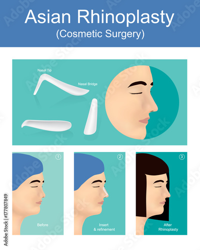 Rhinoplasty is a  plastic surgery creates a aesthetic and facially proportionate nose for correcting or other problems that affect breathing. Illustration vector.