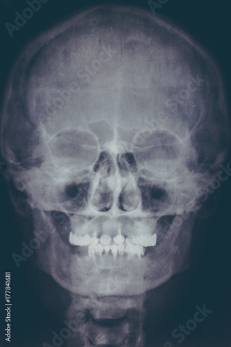 X-ray image or roentgen of human skull, close-up. Head xray scan of skeleton head. Abstract medical concept