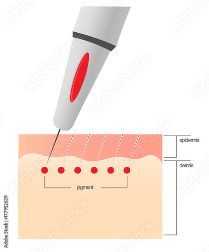 The scheme of the procedure of permanent makeup.