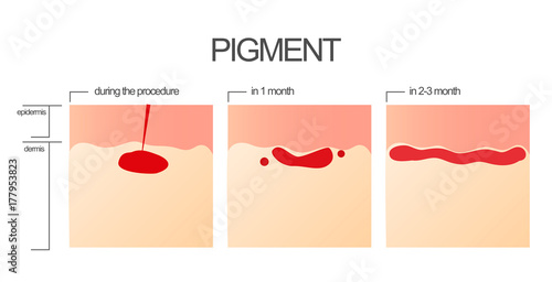 The process of engraftment of the pigment after the salon procedure of permanent make-up.