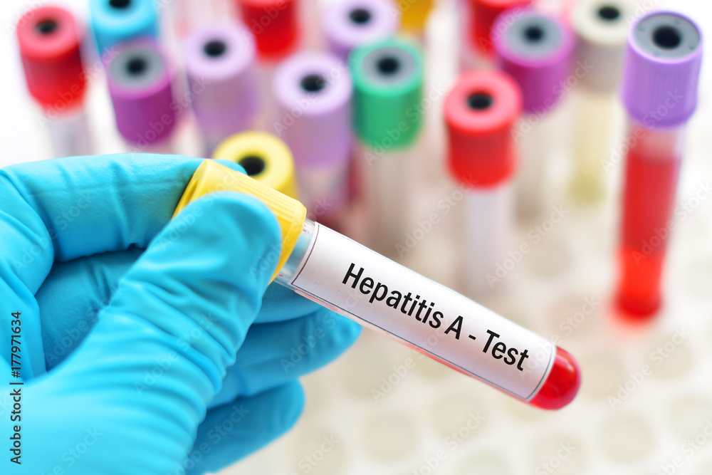 Obraz premium Hepatitis A virus test