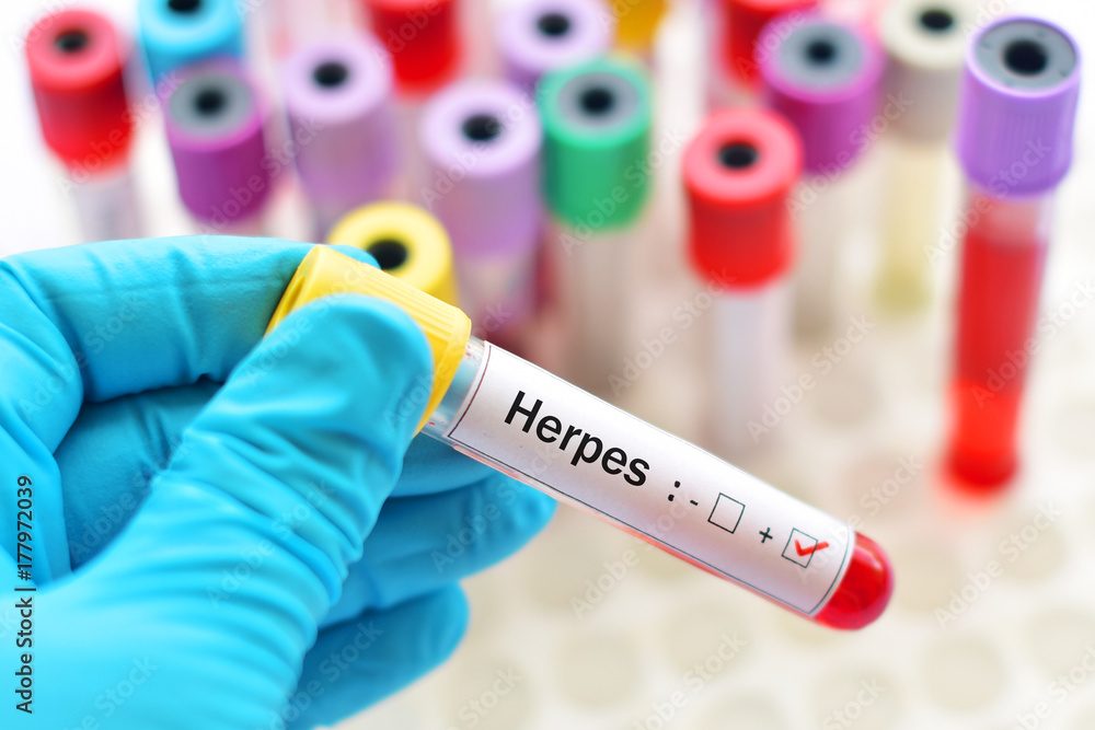 Obraz premium Herpes virus positive