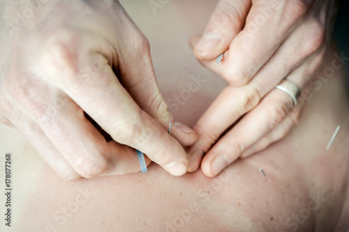 Acupuncturist Hands II photo