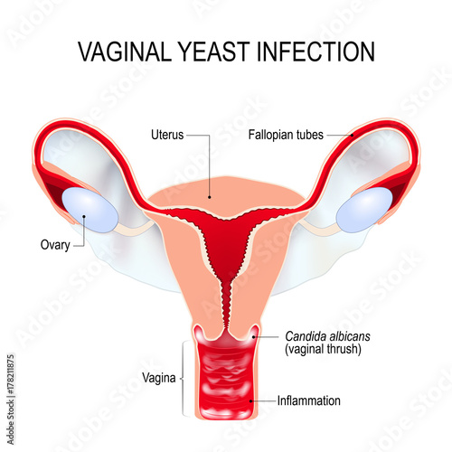 Vaginal yeast infection. vaginal thrush