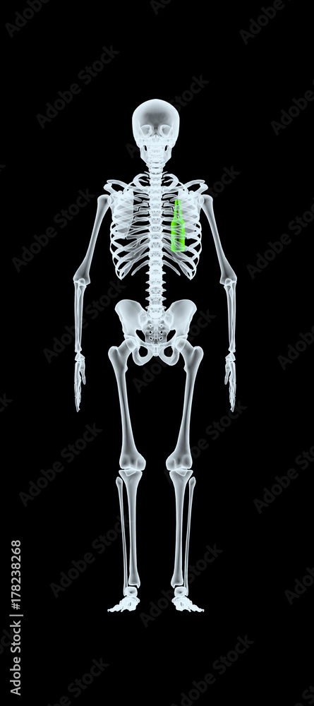 X-ray of a man with beer bottle instead of heart X-ray of a man with beer bottle instead of heart