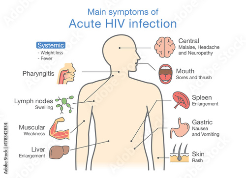 Main symptom of Acute HIV infection. Illustration about diagram for patient.