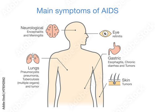 Diagram of Main symptoms of AIDS. illustration about medical.
