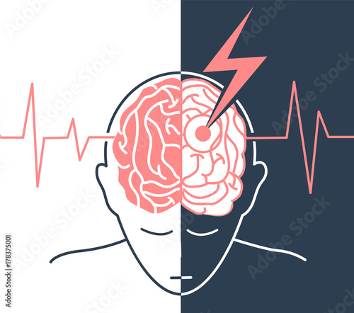 life of the disease is a stroke