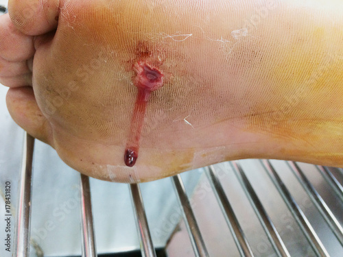 Infected wound at foot. photo