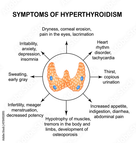 Symptoms of hyperthyroidism. Thyroid. Infographics. Vector illustration on isolated background.