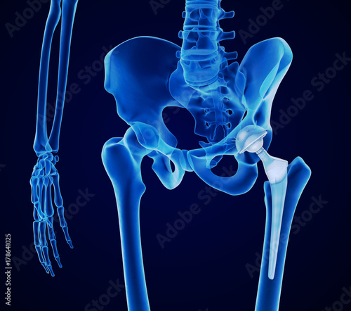 Hip replacement implant installed in the pelvis bone. X-ray view. Medically accurate 3D illustration