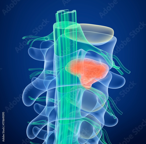 Spinal cord under pressure of bulging disc, 3D illustration photo