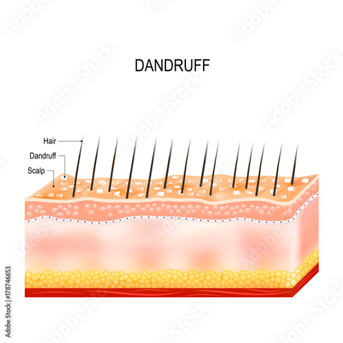 Dandruff on hair scalp. Disorders of the scalp