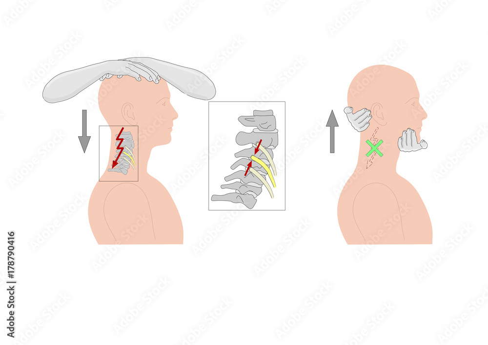 Vetor de the compression test of the head, to exacerbate pain in case