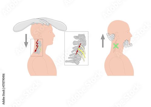 the compression test of the head, to exacerbate pain in case of osteoarthritis, arthrosis etc. The traction test is a verification.