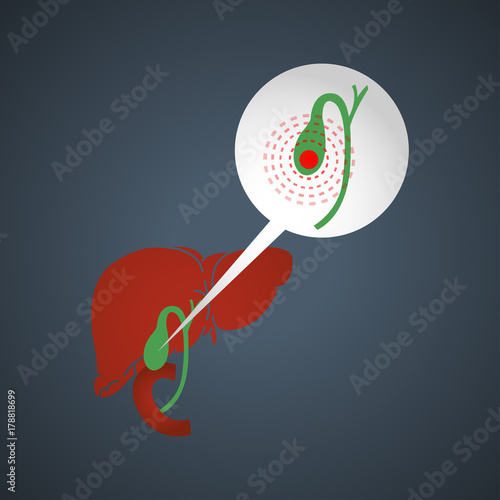 Cholecystitis vector logo icon illustration