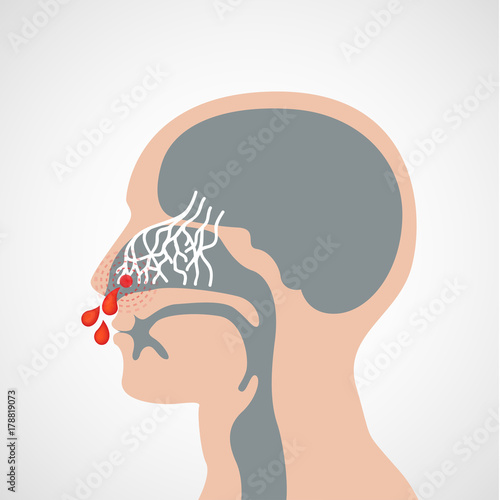 Epistaxis vector logo icon illustration