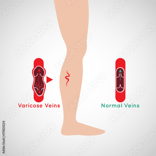 Varicose Veins vector logo icon illustration