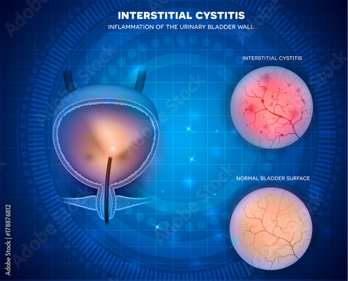 Urinary bladder surface examination with Cystoscope closeup of healthy lining and unhealthy cystitis on an abstract blue background