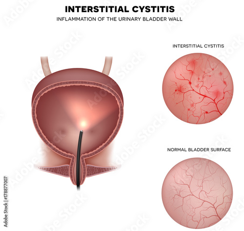 Urinary bladder lining, examination with Cystoscope closeup of healthy lining and unhealthy cystitis