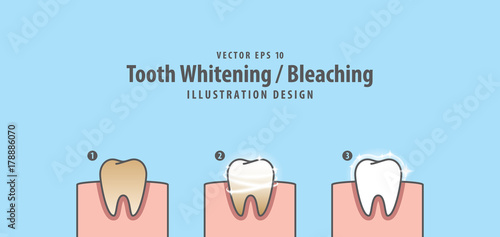 Step of single tooth Whitening-Bleaching and human gum illustration vector on blue background. Dental concept.