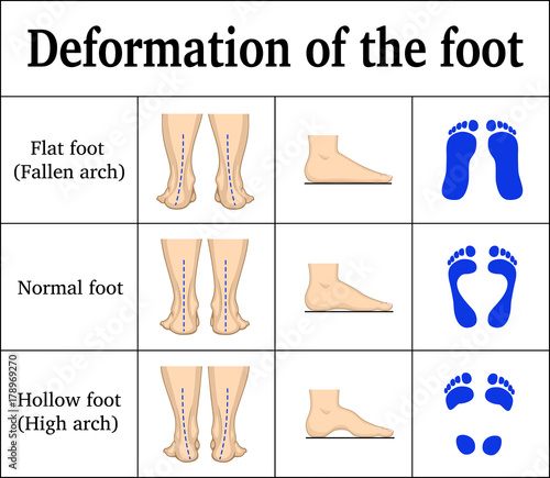 Deformation of the foot