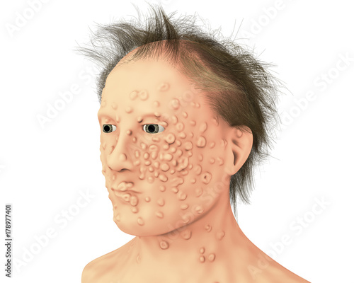 A man with smallpox infection. This infections is caused by variola virus, a virus from Orthopoxviridae family, it is highly contagious disease eradicated by vaccination, 3D illustration photo