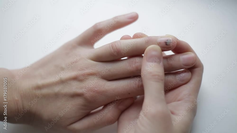 A bruise on the sick nail. Factory accident. Unhealthy damaged finger nail. Girl checks abnormality of the fingernail on a white background. The process of providing self-care in case of domestic A bruise on the sick nail. Factory accident. Unhealthy damaged finger nail. Girl checks abnormality of the fingernail on a white background. The process of providing self-care in case of domestic