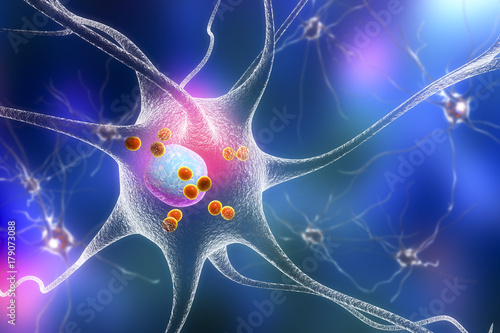 Parkinson's disease. 3D illustration showing neurons containing Lewy bodies small red spheres which are deposits of proteins accumulated in brain cells that cause their progressive degeneration