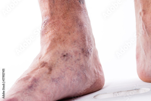 People with varicose veins of the lower extremities and venous thrombophlebitis and standing on a white background photo