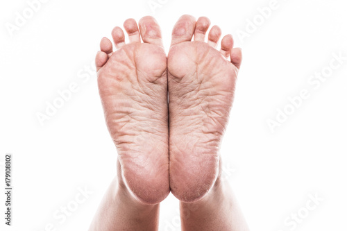 female foot with pedicure and poor over-dry skin on the heels of a close-up on a white background © Ivan Traimak