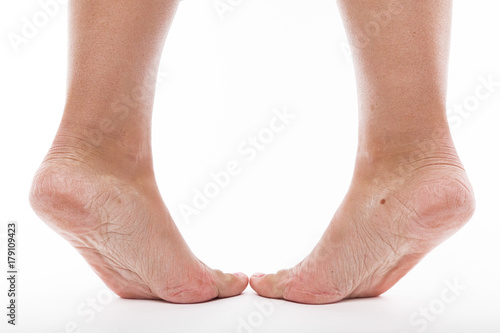 Canvas-taulu dehydrated skin on the heels of female feet
