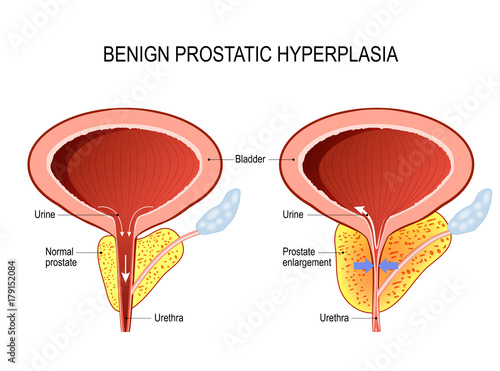Benign prostatic hyperplasia (BPH). prostate enlargement