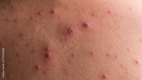 Obraz na plátně Chicken pox rash