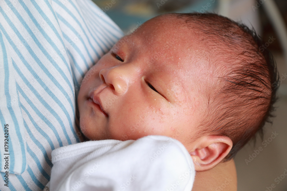 newborn baby is allergic to milk,there is rash on face newborn baby is allergic to milk,there is rash on face