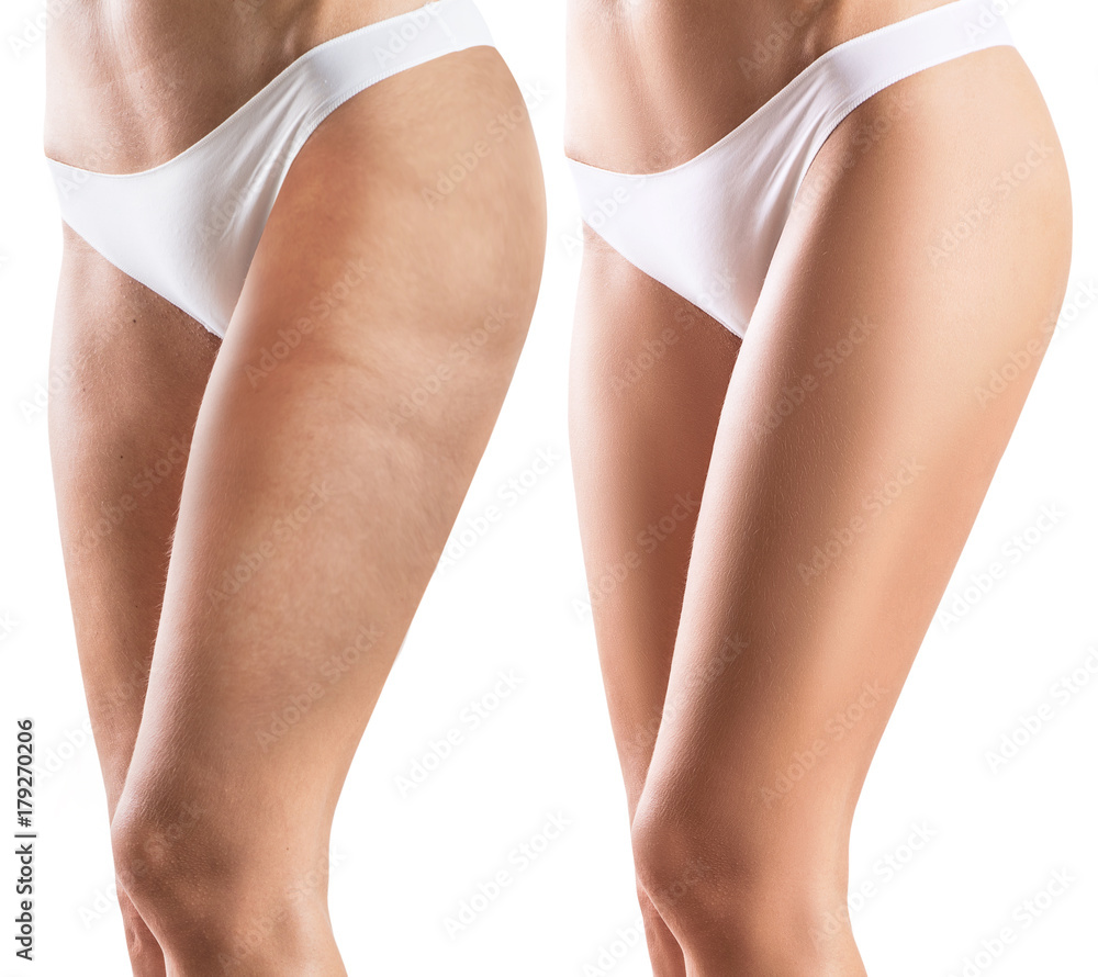 Woman legs before and after treatment skin. Stock Photo Adobe Stock