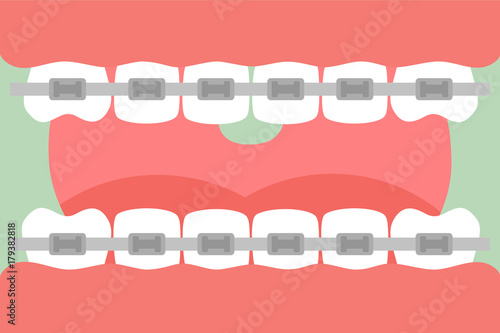 orthodontics teeth or dental braces, open mouth with healthy teeth and tongue
