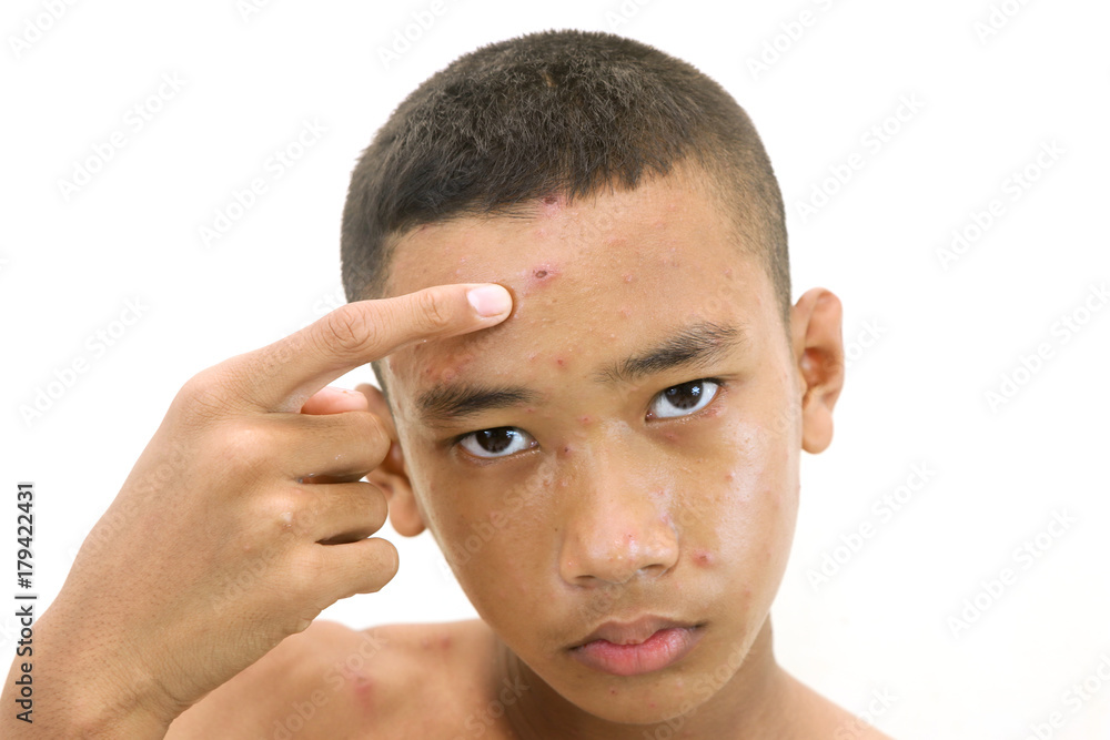 Obraz premium Chickenpox bubble rash on a boy.