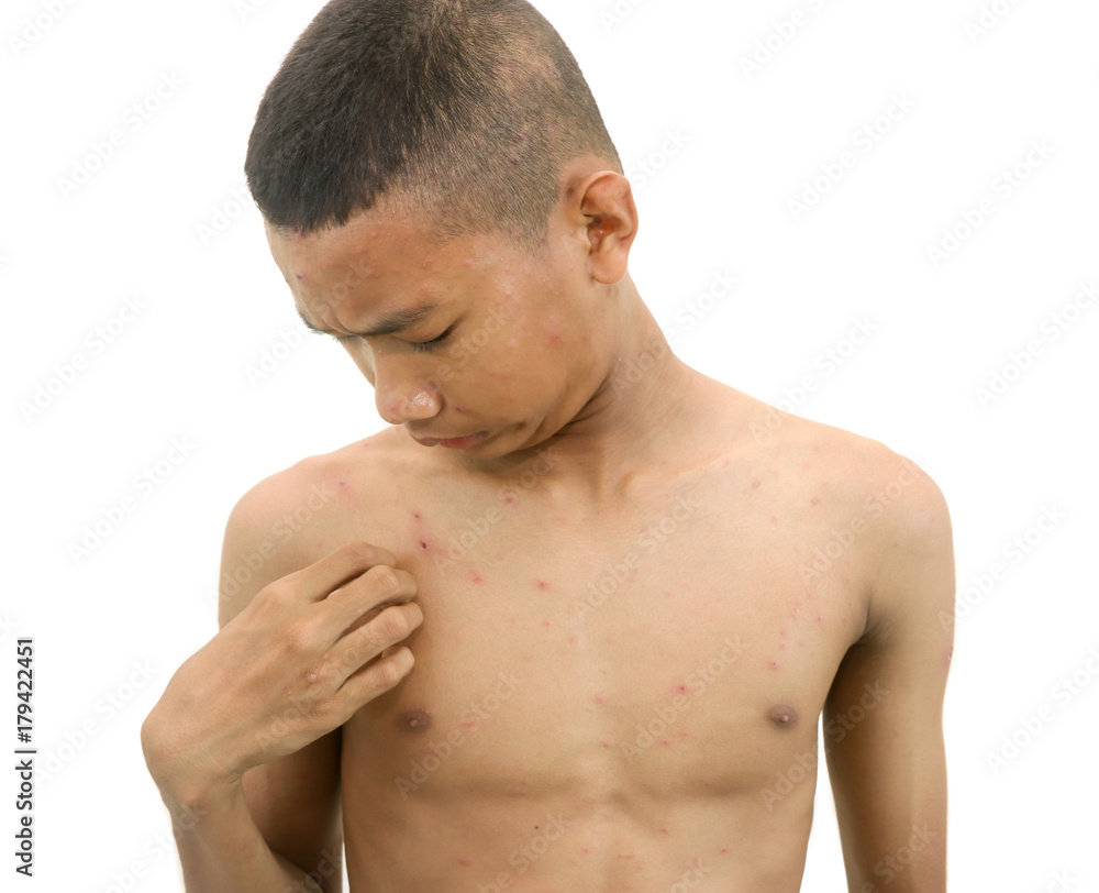 Chickenpox bubble rash on a boy.