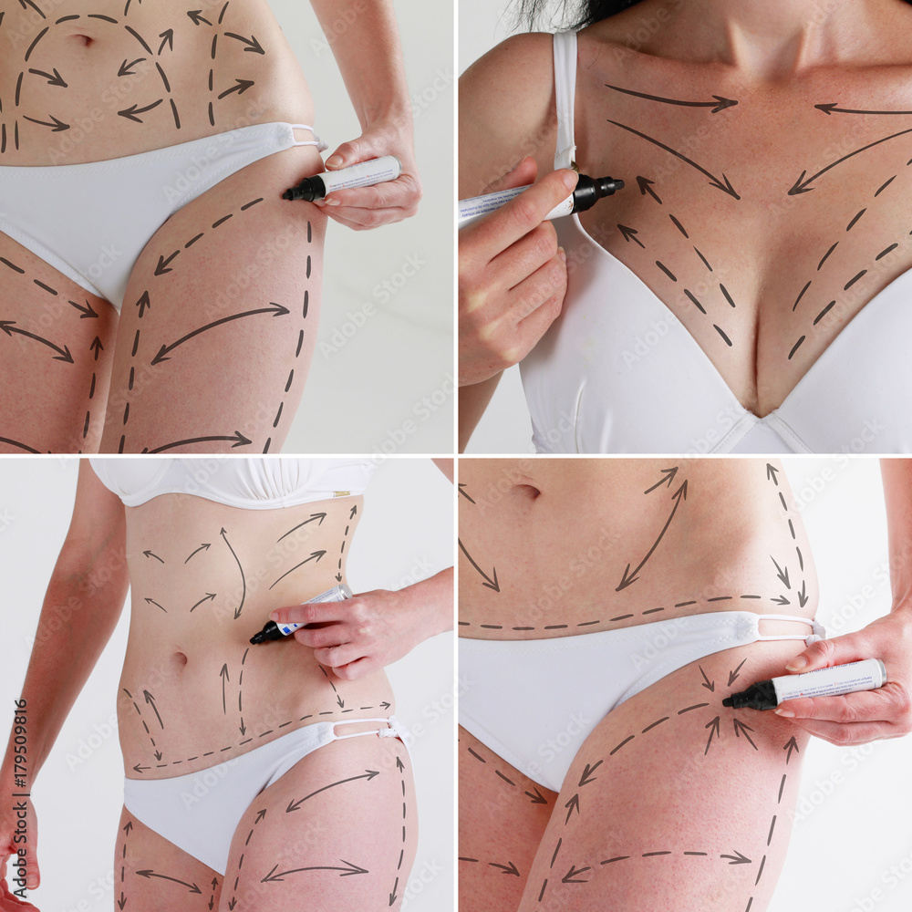 Cellulite removal arrow scheme. Markings on body woman. Plastic surgery.  Set of photos. Stock Photo