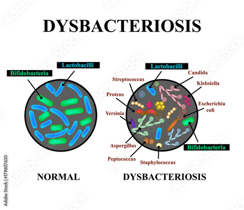 Dysbacteriosis of the intestine. Lactobacillus, Bifidobacteria, Streptococcus, Staphylococcus, E. coli, Aspergyllus mushrooms, Candida. Infographics. Vector illustration on isolated background. photo