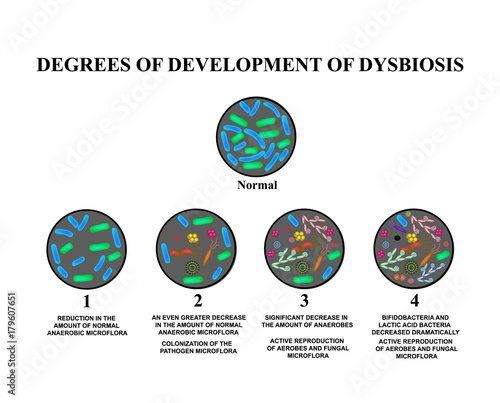 4 degrees of development of dysbiosis. Dysbacteriosis of the intestine. The large intestine. dysbiosis of colon. Bacteria, fungi, viruses. Infographics. Vector illustration on isolated background. photo