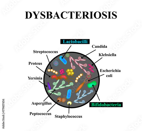 Dysbacteriosis of the intestine. Lactobacillus, Bifidobacteria, Streptococcus, Staphylococcus, E. coli, Aspergyllus mushrooms, Candida. Infographics. Vector illustration on isolated background.