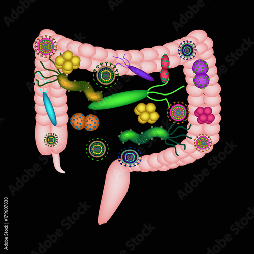 Dysbacteriosis of the intestine. The large intestine. dysbiosis of colon. Bacteria, fungi, viruses. Infographics. Vector illustration on black background.